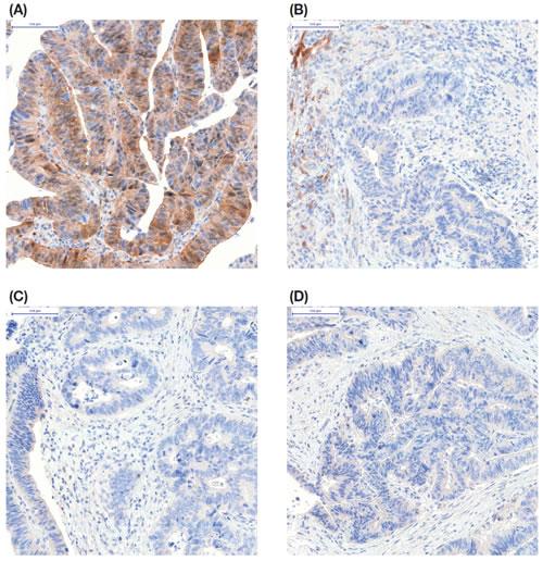 Representative immunohistochemistry for pAKT on formalin-fixed colon cancer tissue from one patient taken at four timepoints: (A) biopsy presurgery; (B) tissue fixed 10 minutes after resection; (C) tissue fixed 20 minutes after resection; and (D) tissue fixed 45 minutes after resection.