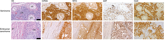 CIP2A is co-expressed with MYC, ki67 and Oct4 in testicular cancers.