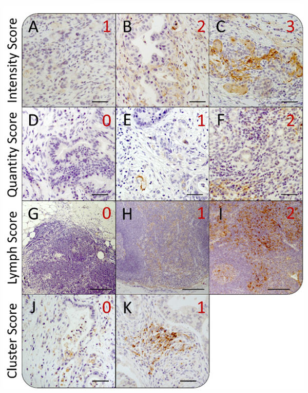 Heterogeneity of intratumoral PD-L1 expression in pancreatic tissue sections from PDAC patients.