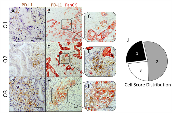 PD-L1 expression in PDAC is not restricted to epithelial/tumor cells, but is localized to a large extent within the tumor stroma.