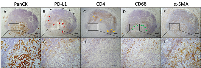 Polarized PD-L1 expression at tumor-lymph follicle interface coincides with the presence of CD4+ T cells and CD68+ macrophages.