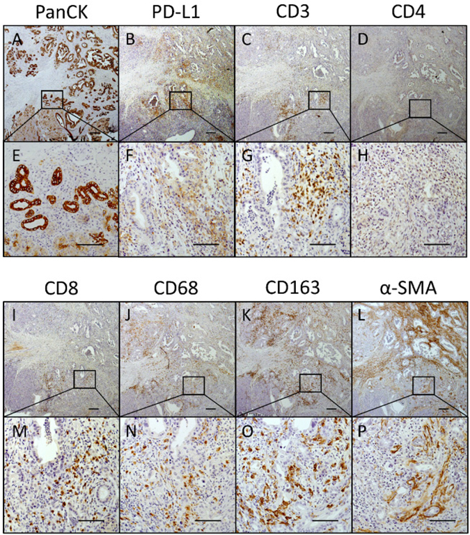 PD-L1 is markedly expressed within tumor areas that show high proportion of CD8+ T cells, macrophages and myofibroblasts.