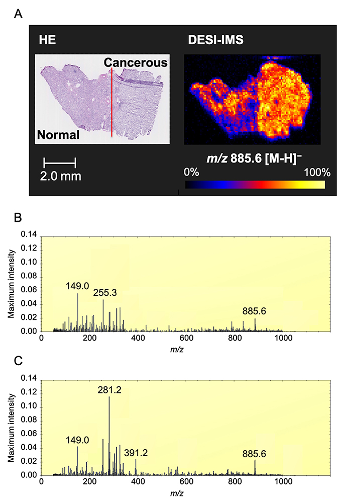 Optimal image of ccRCC by DESI-IMS.