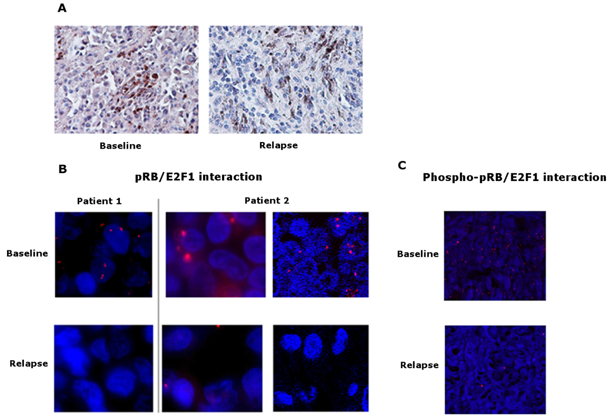 pRB expression and pRB/E2F1 interaction in tumors.