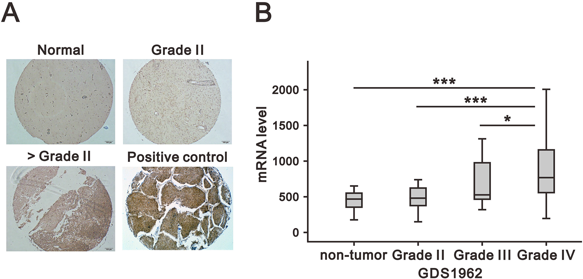 Association of CD164 expression in glioma with clinicopathological parameters.