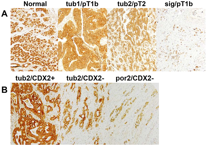 CLDN4 expression in gastric adenocarcinomas.