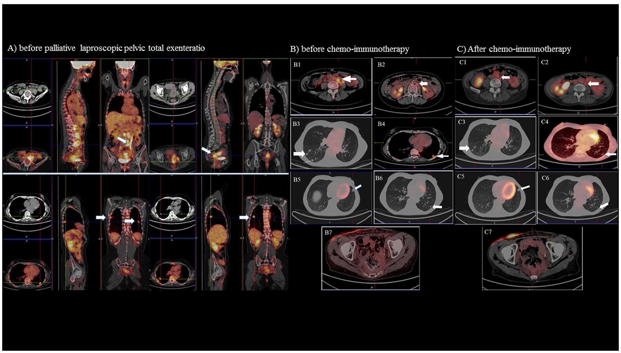 Positron emission tomography (PET) and computed tomography (CT) imaging.
