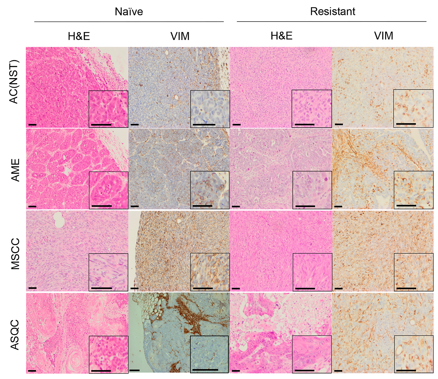 Figure 1: H&E and vimentin staining of tumour phenotypes observed in olaparib-na�ve and olaparib-resistant tumours in the Brca2/p53-mutant mammary tumour model.