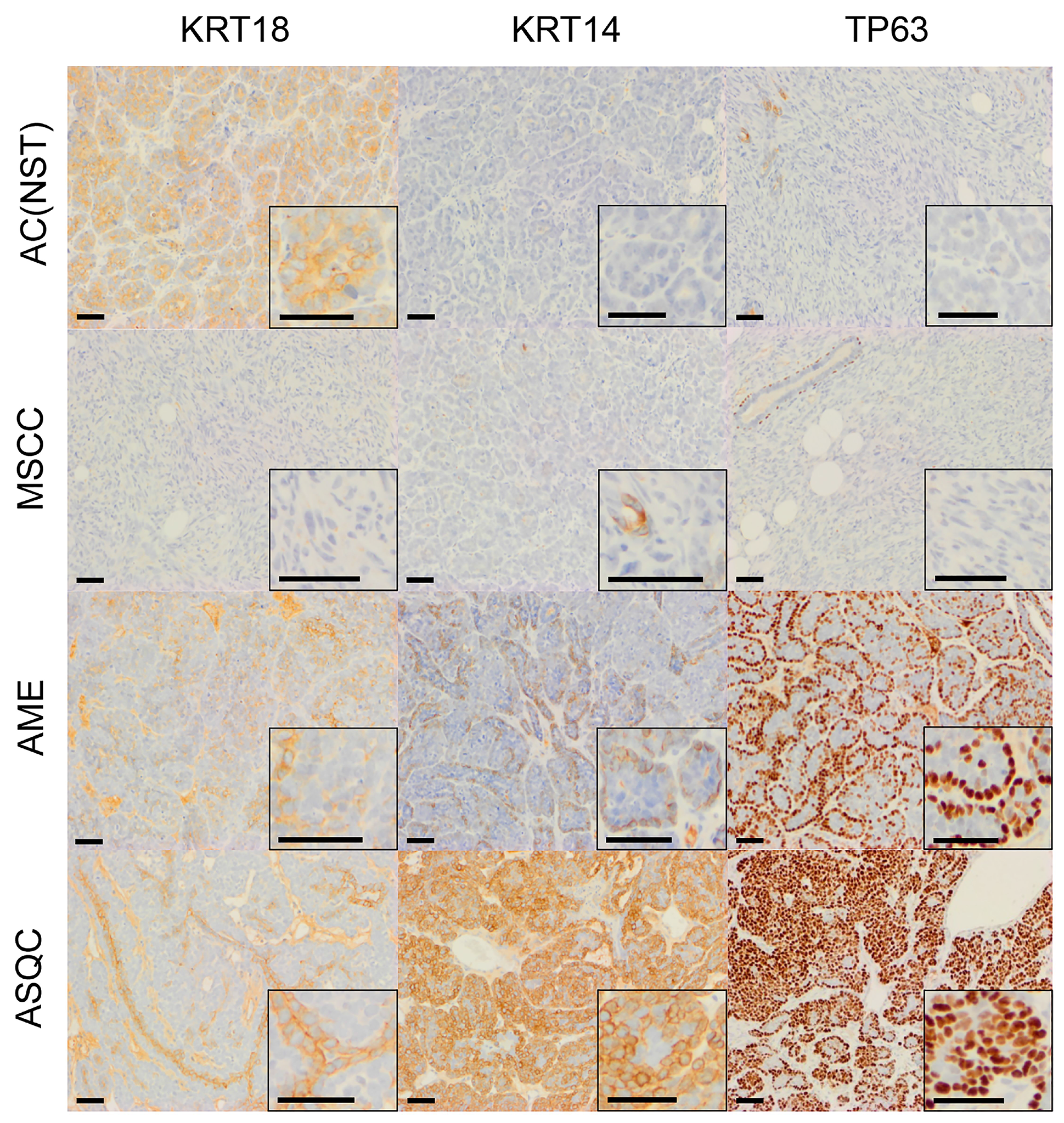 Immunohistochemical staining of olaparib-naïve tumours of different phenotypes in the Blg-Cre Brca2/p53-mutant mammary tumour model.