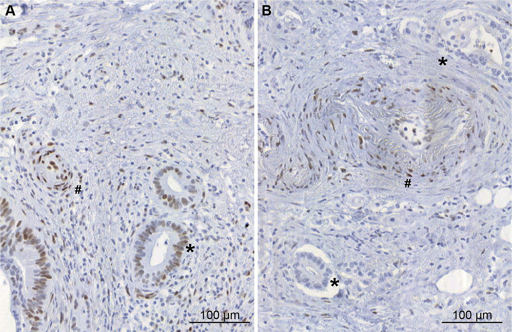 Immunohistochemical study of pSTAT3 expression in pancreatic adenocarcinoma tissues