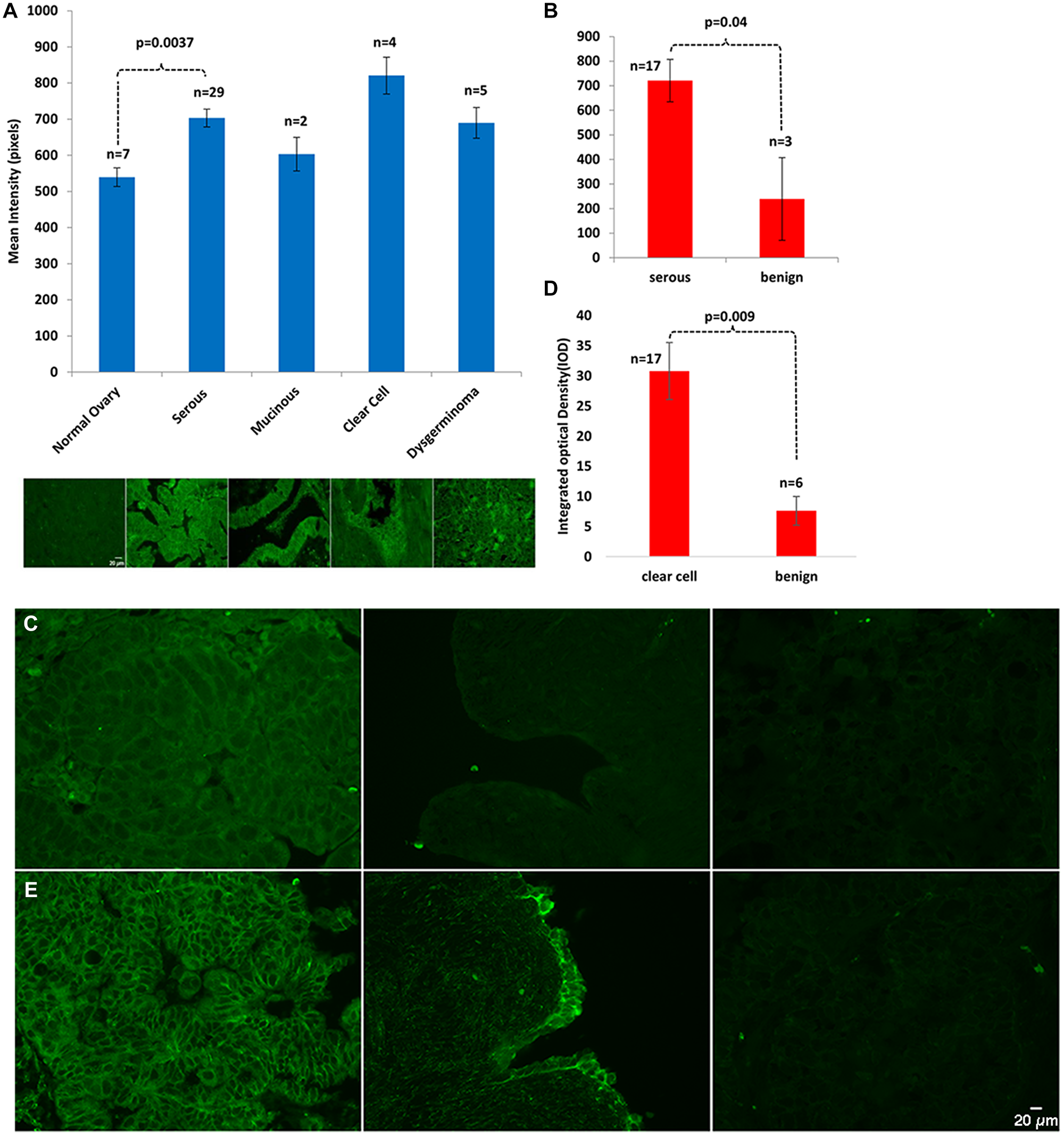 Figure 1: Septin-2 is overexpressed in EOC.