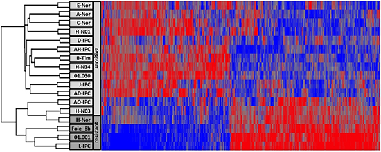 RNA expression analysis of PDAC.