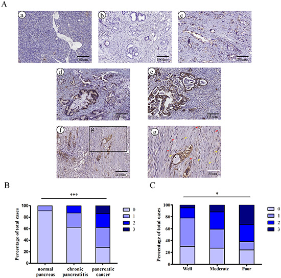 The embryonic protein Nodal is expressed in pancreatic ductal adenocarcinoma.