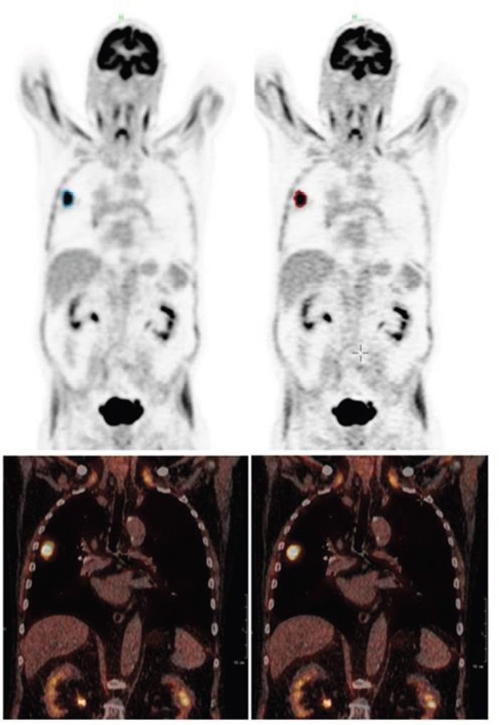 Patient example (Patient 1): coronal PET (top) and fused PET/CT (bottom) of the uncorrected (left) and corrected (right) data set.