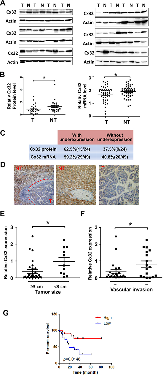 Downregulation of Cx32 in HCC tissues is associated with a poor prognosis for HCC patients.