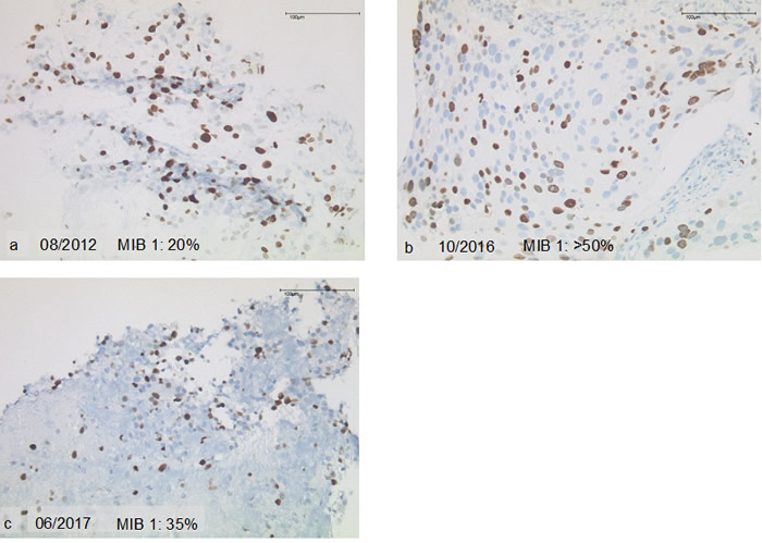 Proliferation during the course of disease.