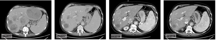 Metastases of the liver during the checkpoint-inhibition with pembrolizumab.