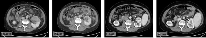 Renal metastases in CT-staging before and after the therapy with pembrolizumab.