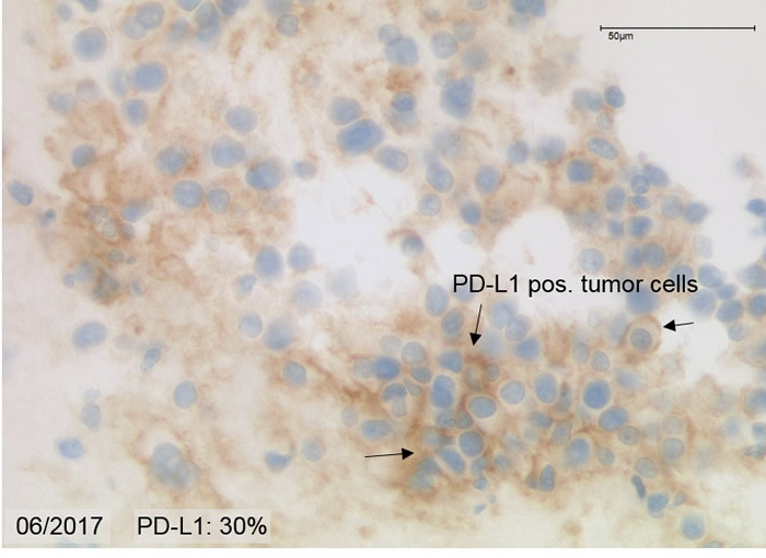 PD-L1 Immunoreactivity in 06/2017.