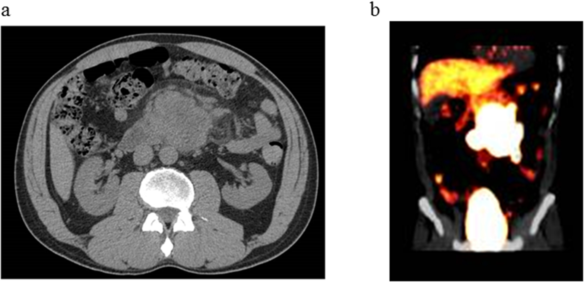 Radiological images of abdominal tumor.
