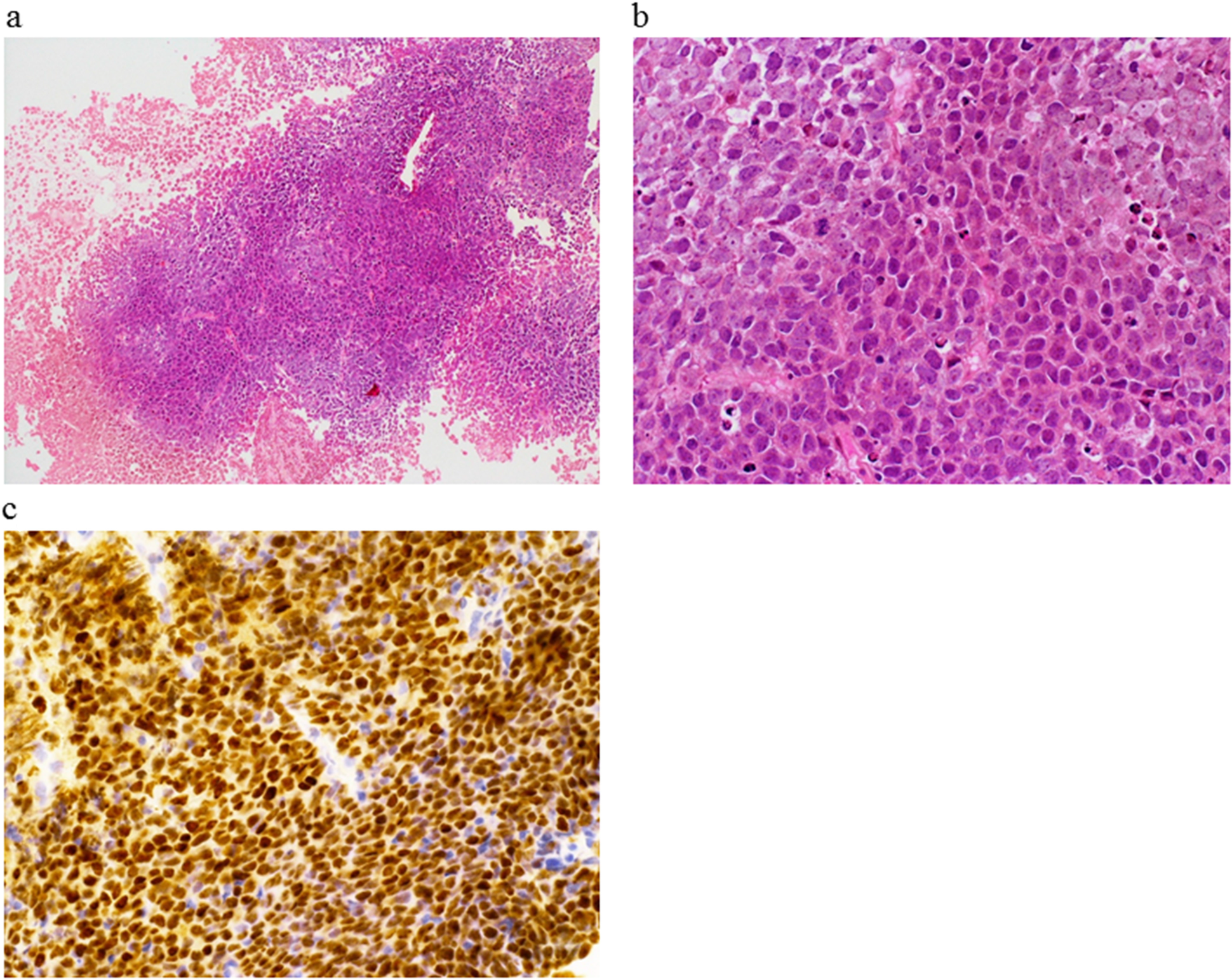Histological findings of the abdominal tumor at histological transformation.