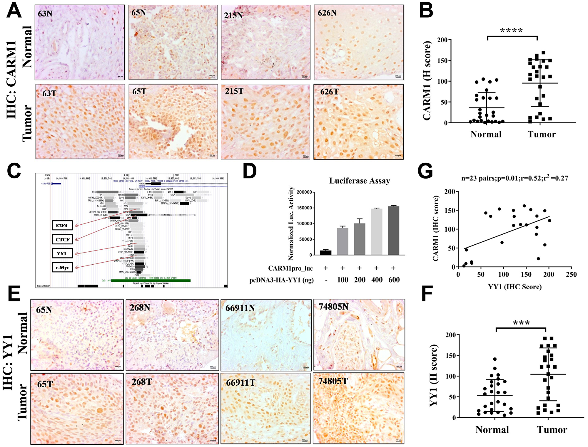 CARM1 and YY1 are overexpressed in oral cancer patient tumor tissue.