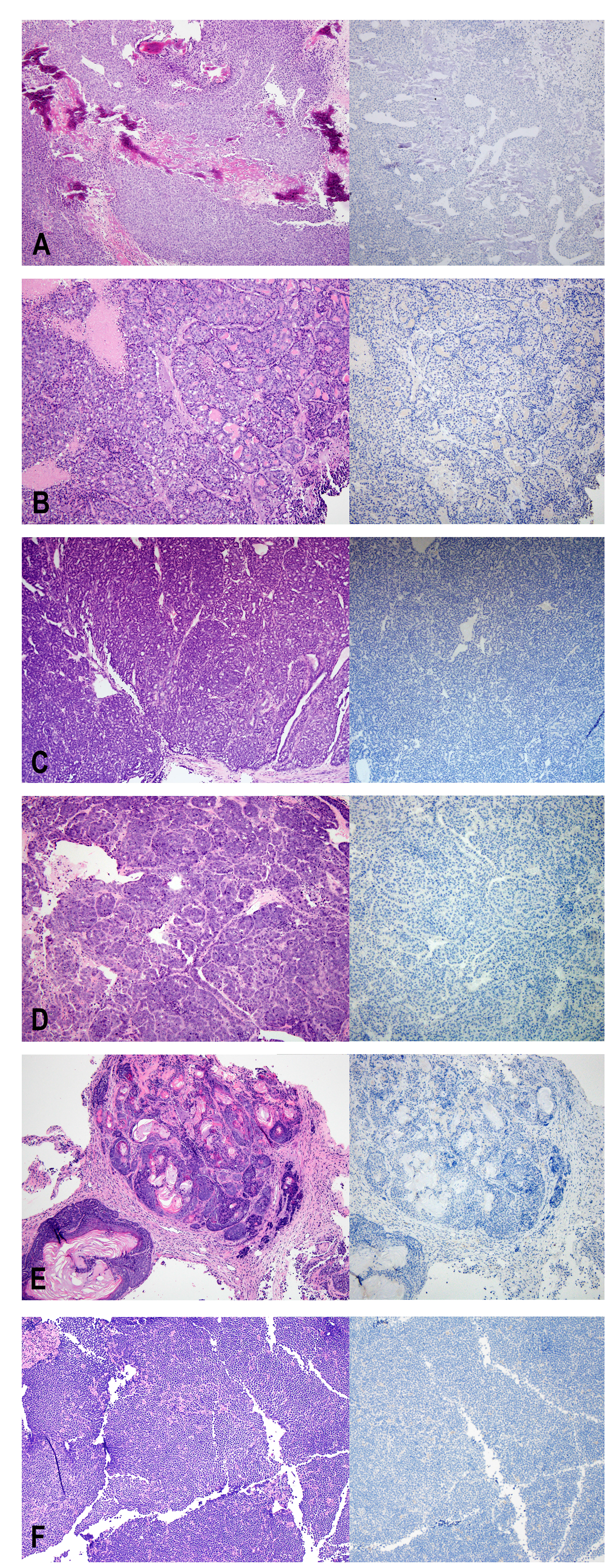 H&E (left) and Ki67 (right) staining of non-human tumors identified at the injection site.