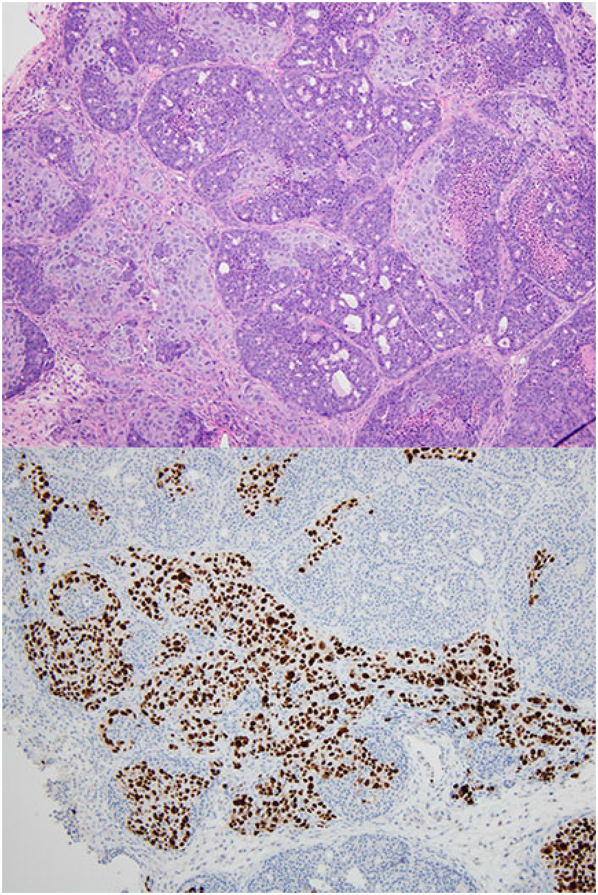 Collision tumor of mouse mammary tumor and patient-derived xenograft.