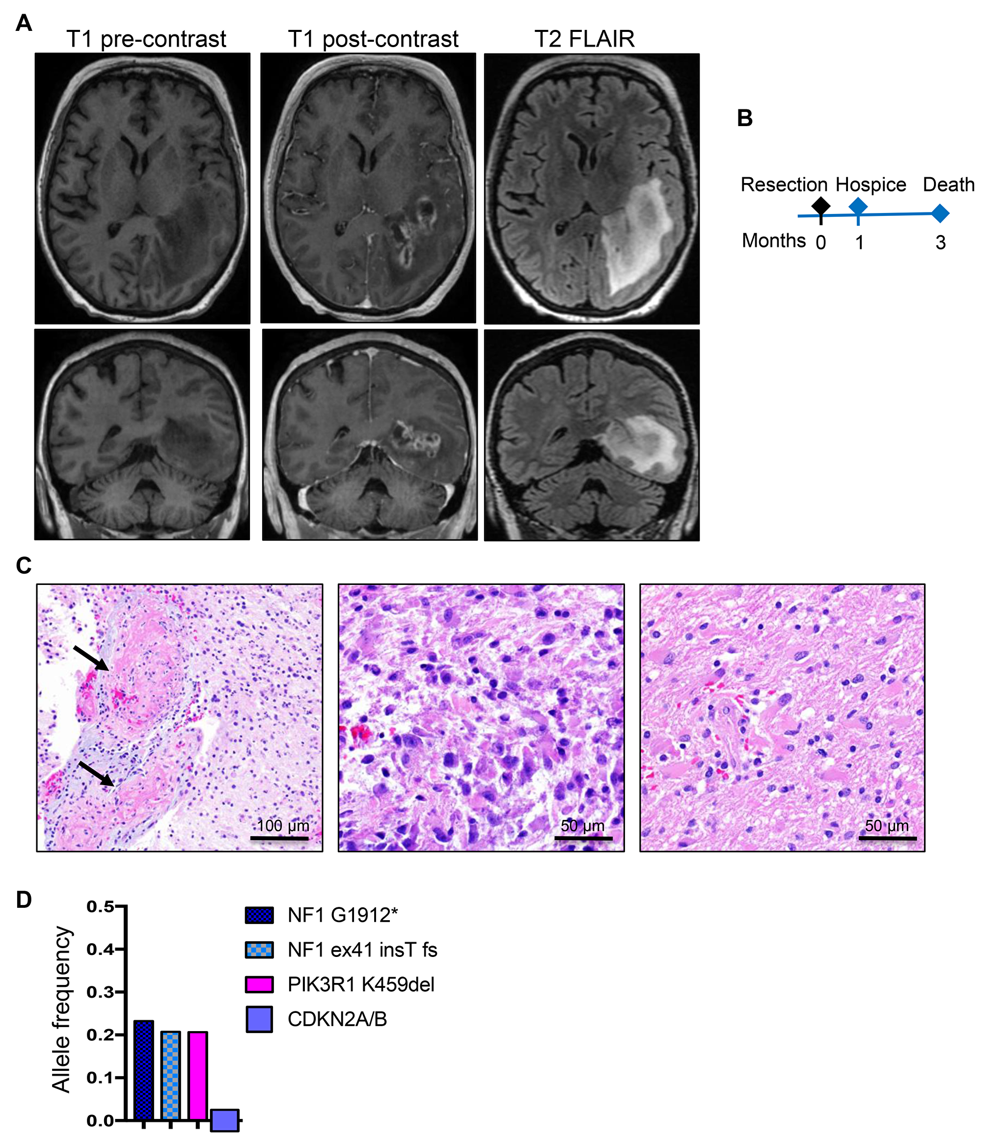 Patient 2: Aggressive periventricular glioblastoma with NF1 mutations and 3-month survival.