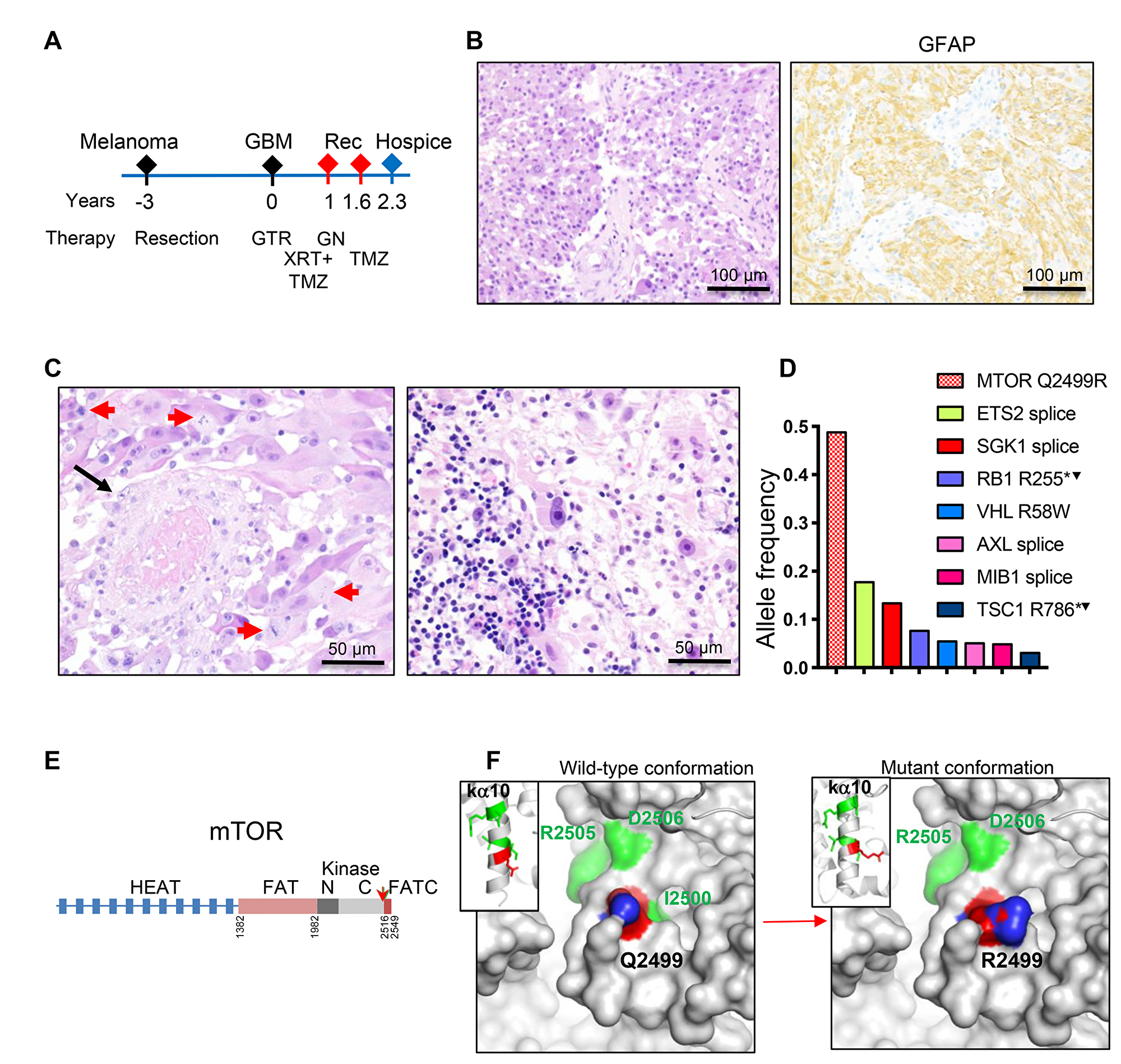 Patient 3: Intraventricular glioblastoma with MTOR mutation and over 2-year survival.