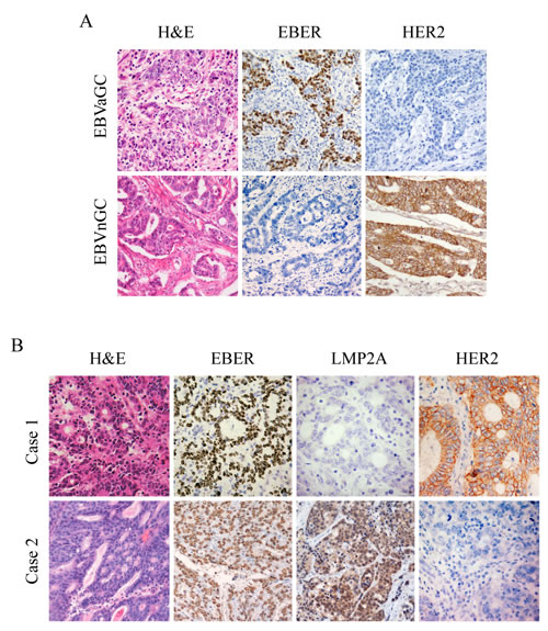 IHC images for expression of HER2, EBER and LMP2A in gastric tumor specimens.