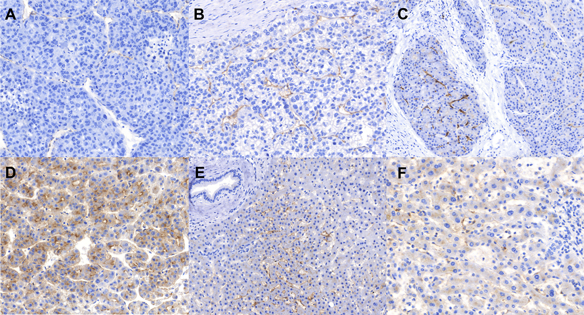 Immunohistochemistry staining patterns of PSMA.