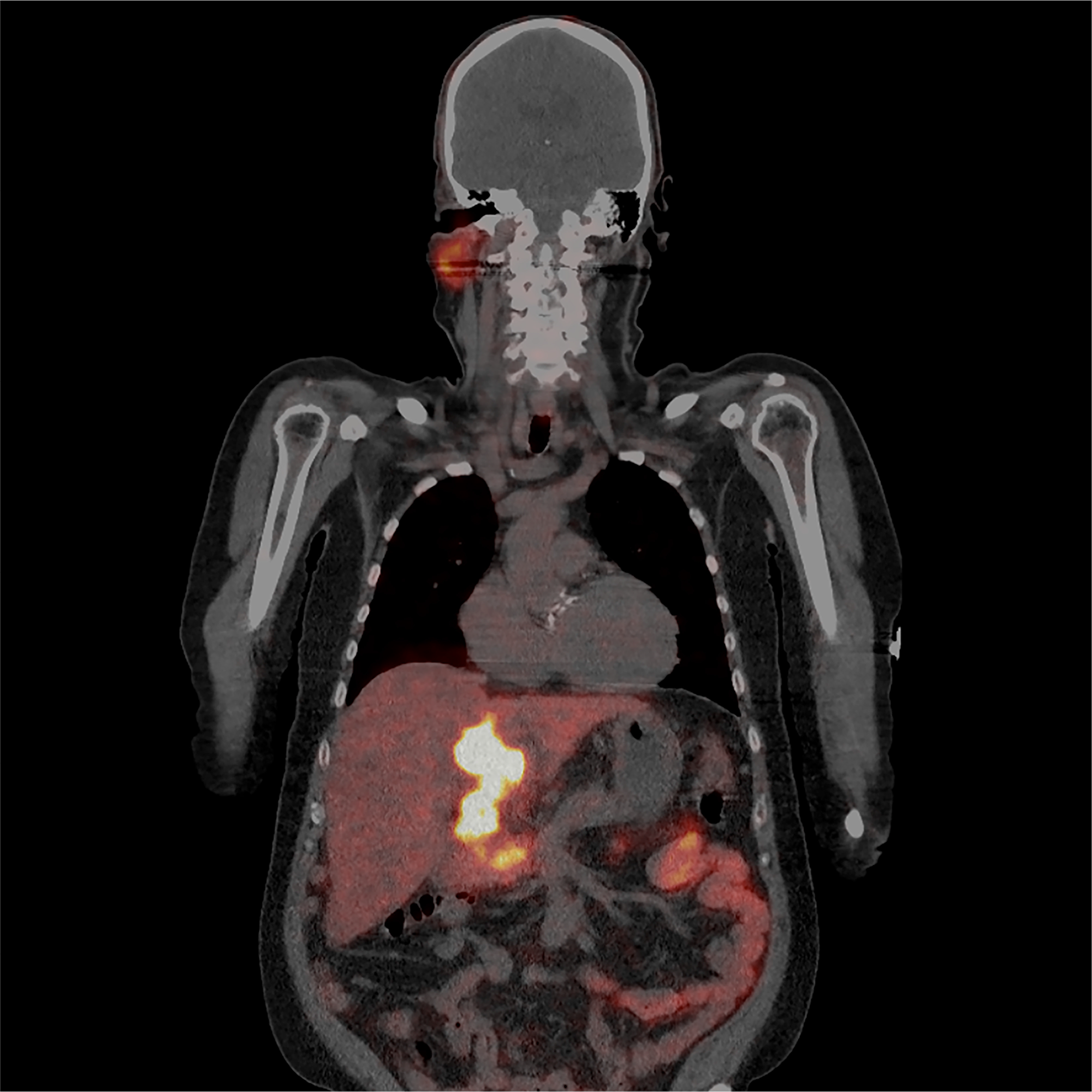 A 62-year-old patient with liver cirrhosis was diagnosed with HCC in 2015.