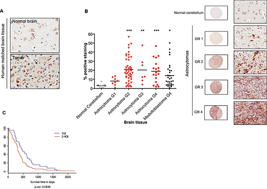 Upregulation of p32 in malignant brain tumors.