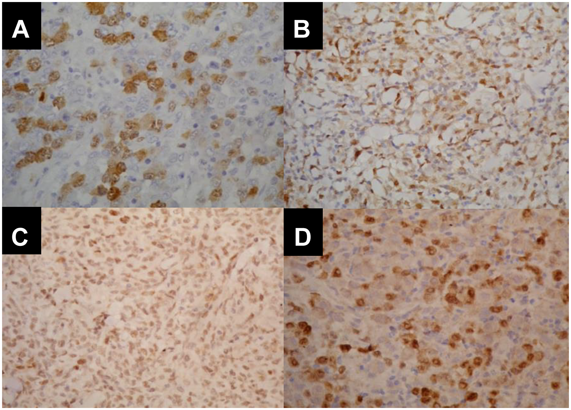 Immunohistopathological pattern of CCNA2, TOP2A, NFkB and CHEK1 expression in different histopathological subtypes of nodal PTCL.