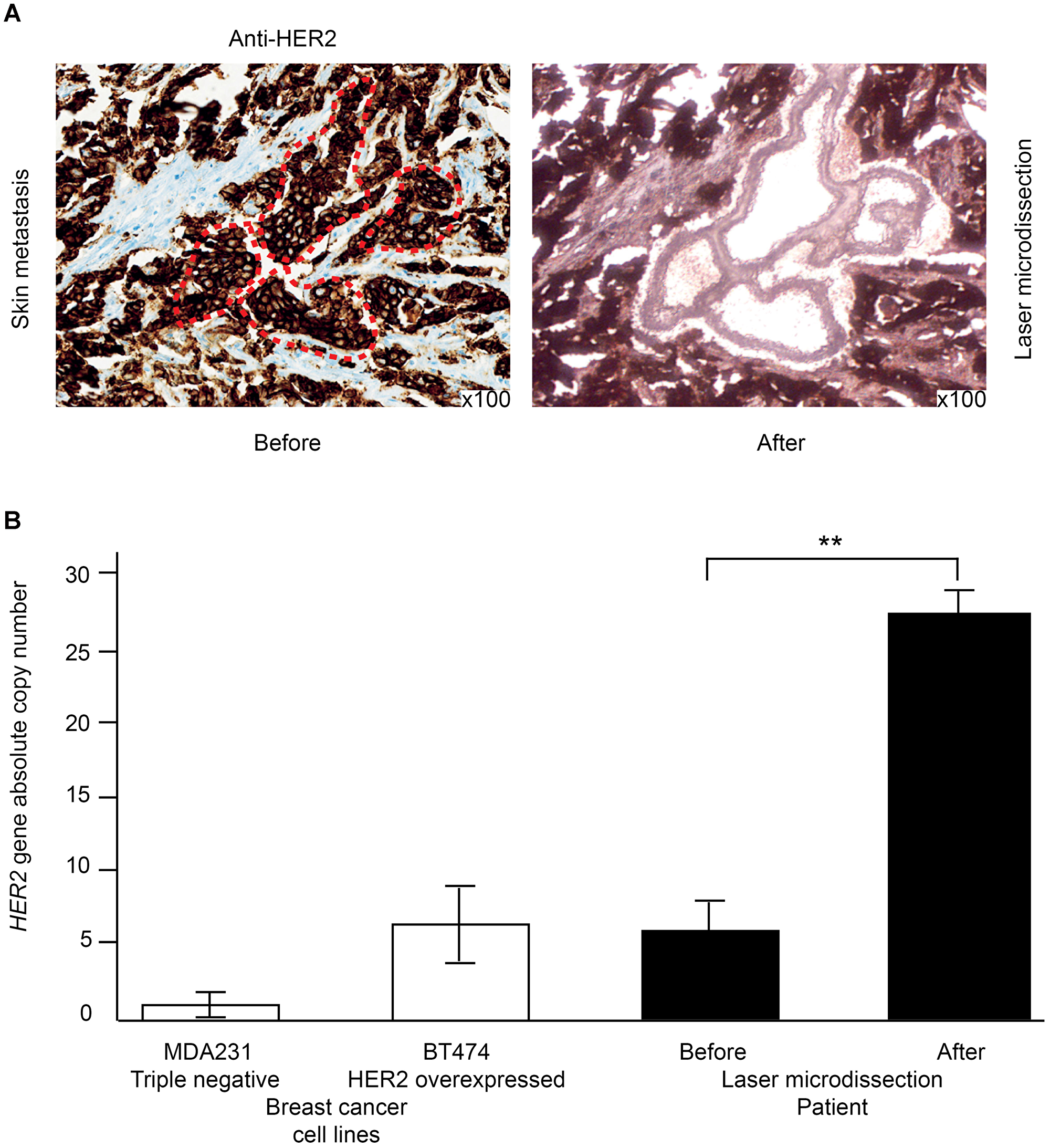 Laser-microdissection of cancer cells combined with ddPCR to precisely assess HER2 amplification level on a skin metastasis of recurrent HER2-overexpressing breast cancer.