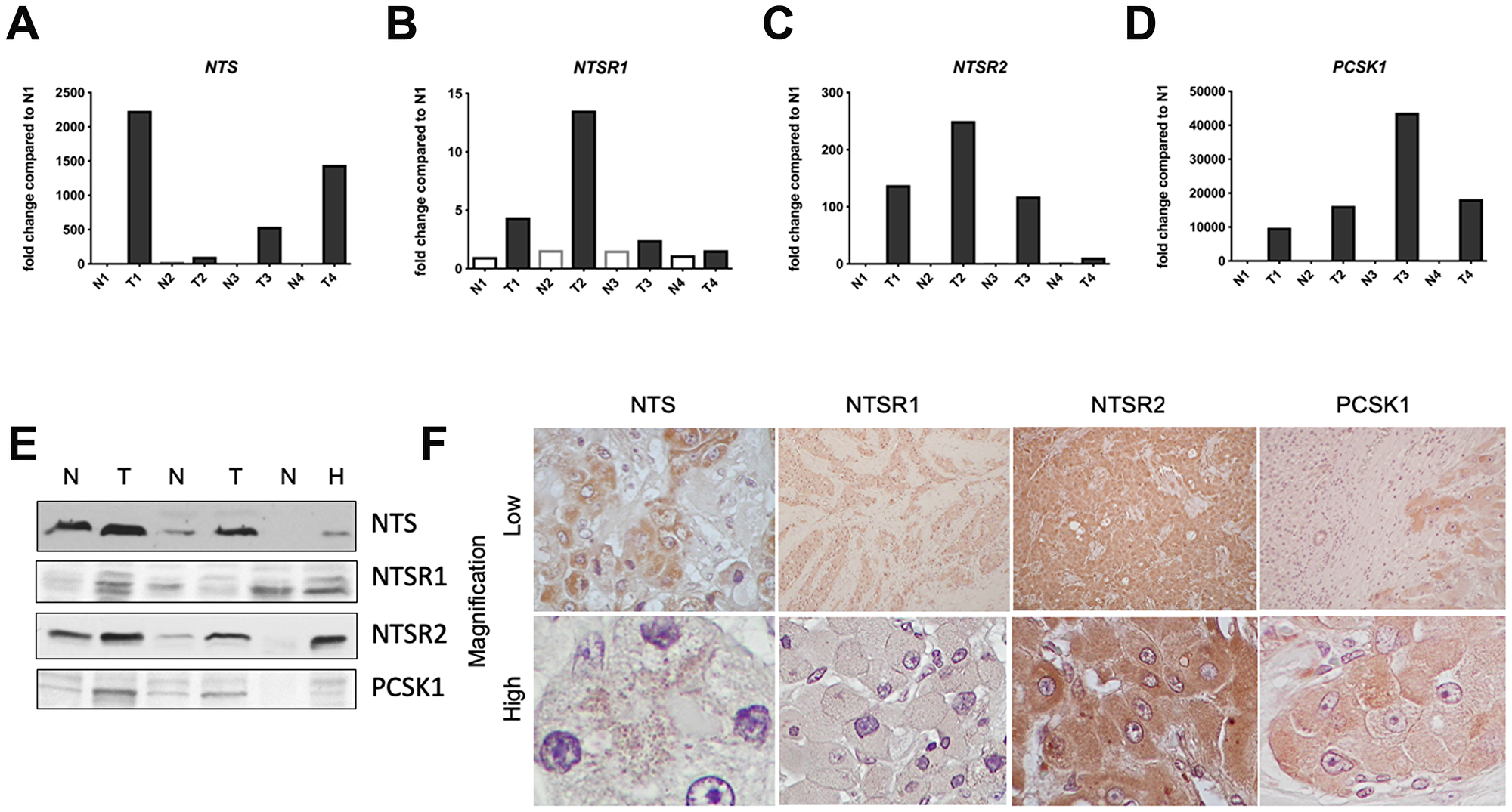 Neurotensin pathway mRNA and protein expression in FL-HCC.