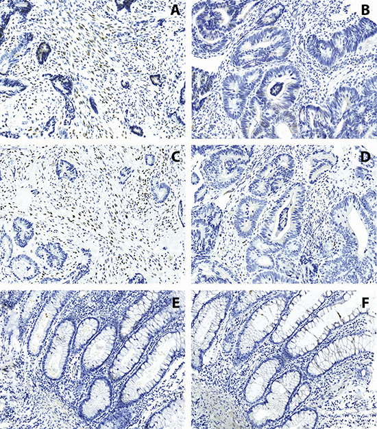 Immunohistochemistry of TWIST1 (A, B) and TWIST2 (C, D) on colorectal cancers and (E, F) normal colonic tissues.