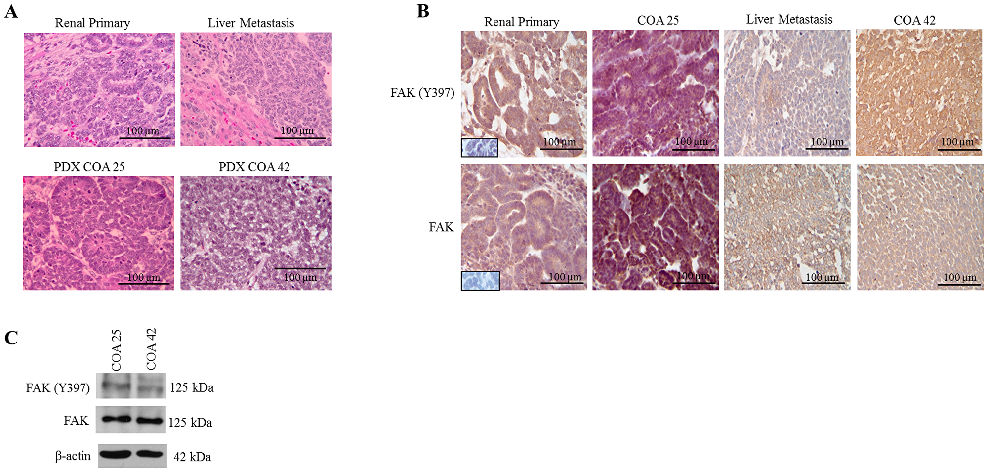 FAK in human Wilms tumor (WT) samples and patient derived xenografts (PDX).