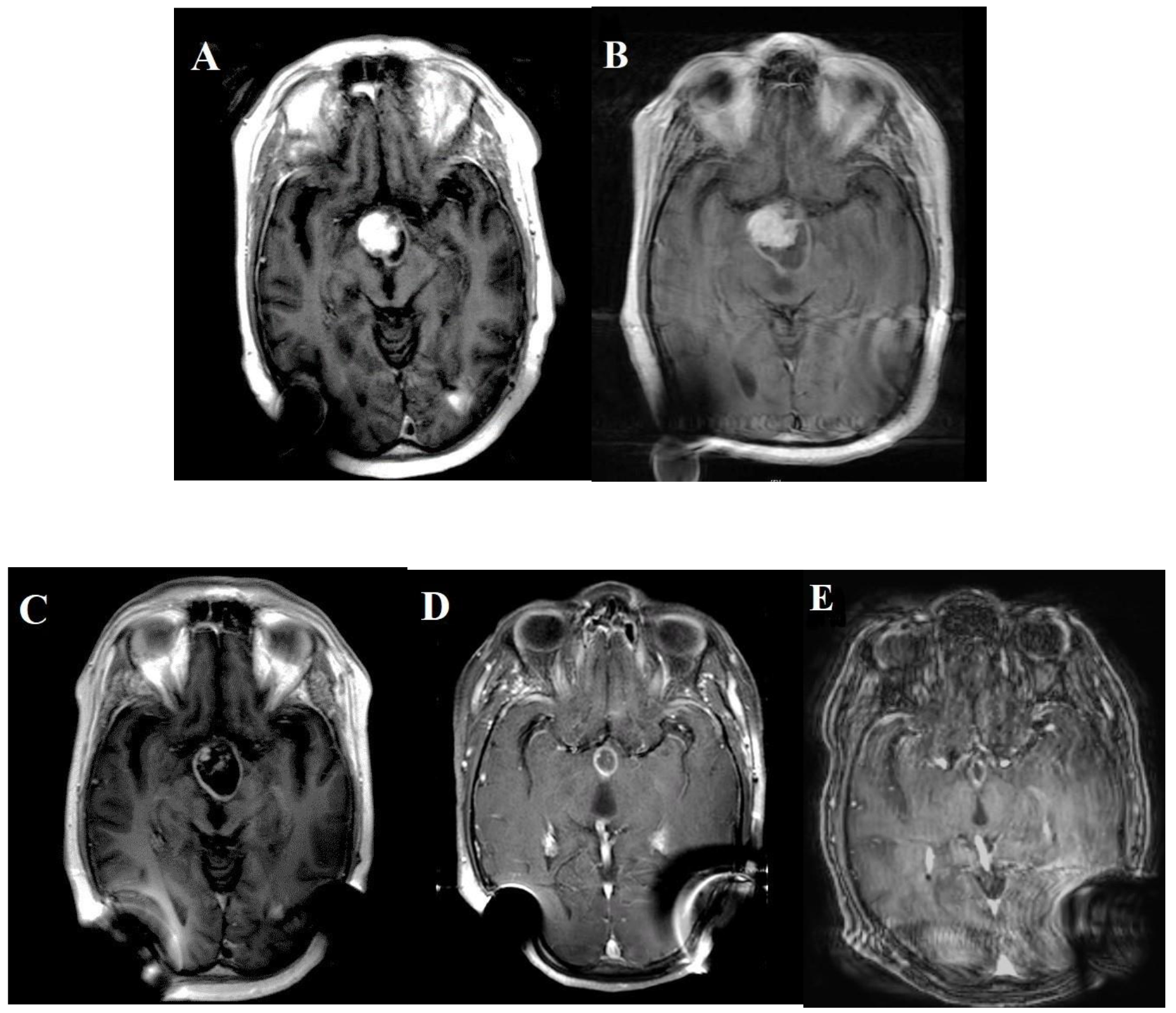 MRI brain before BRAF inhibitor was introduced (both A & B).