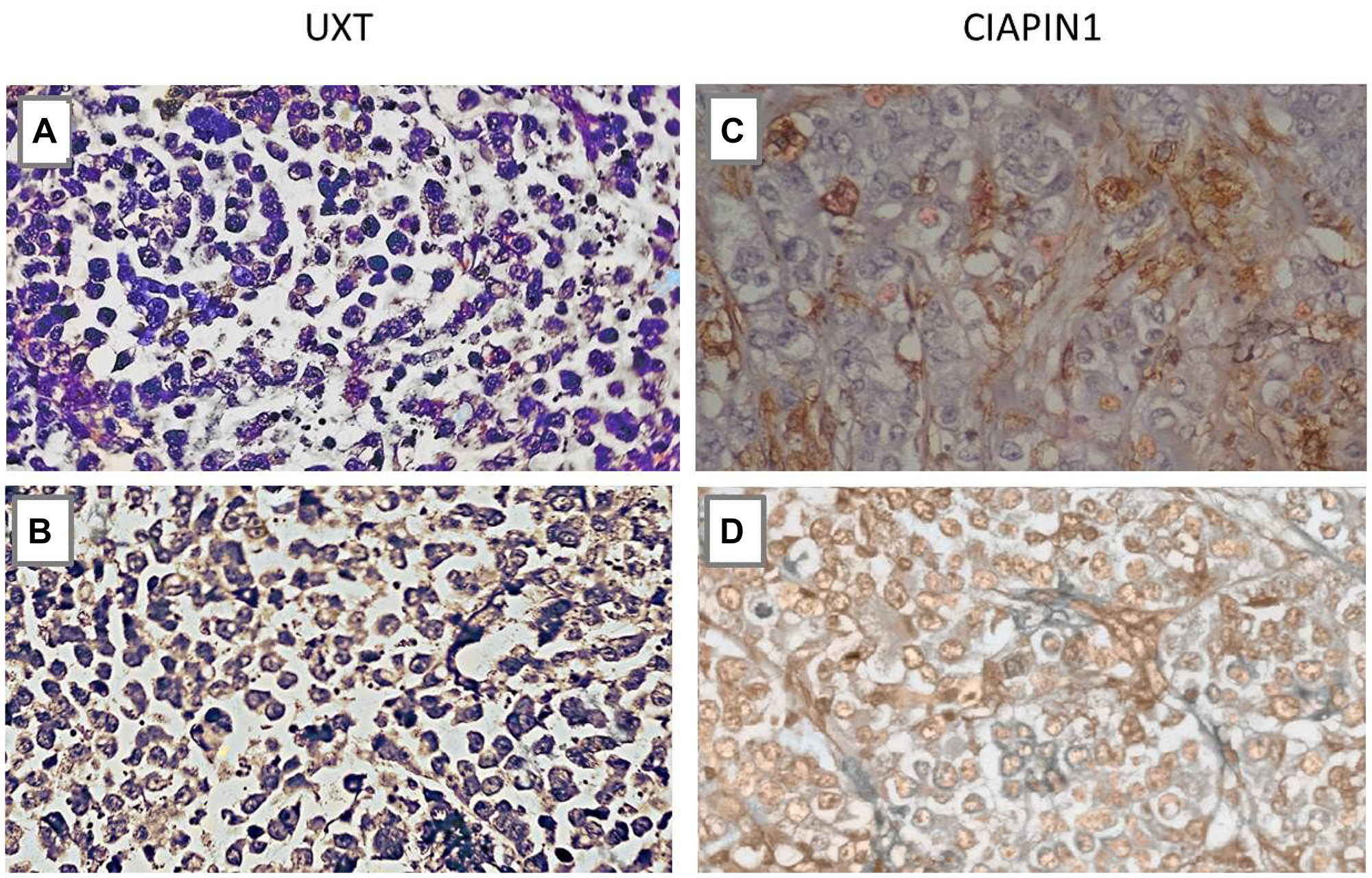 Immunohistochemistry analysis of the UXT and CIAPIN1 proteins in primary gastric tumor tissues of patients without metastasis (M0) and with metastasis (M1).