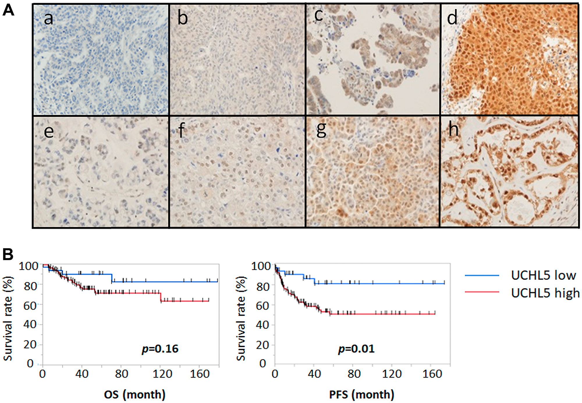 Immunohistochemical staining pattern of UCHL5 in ovarian cancer.