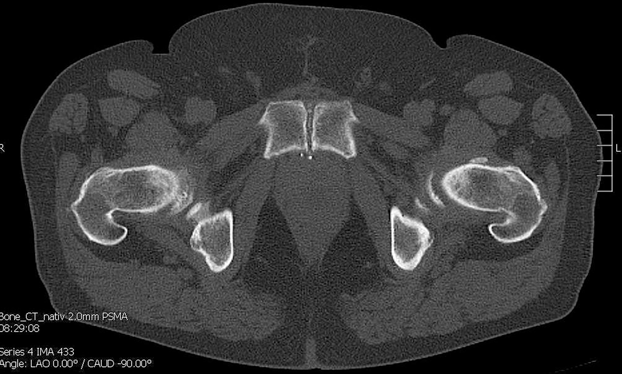 CT shows no bone metastasis in the symphyseal os pubis on the left.