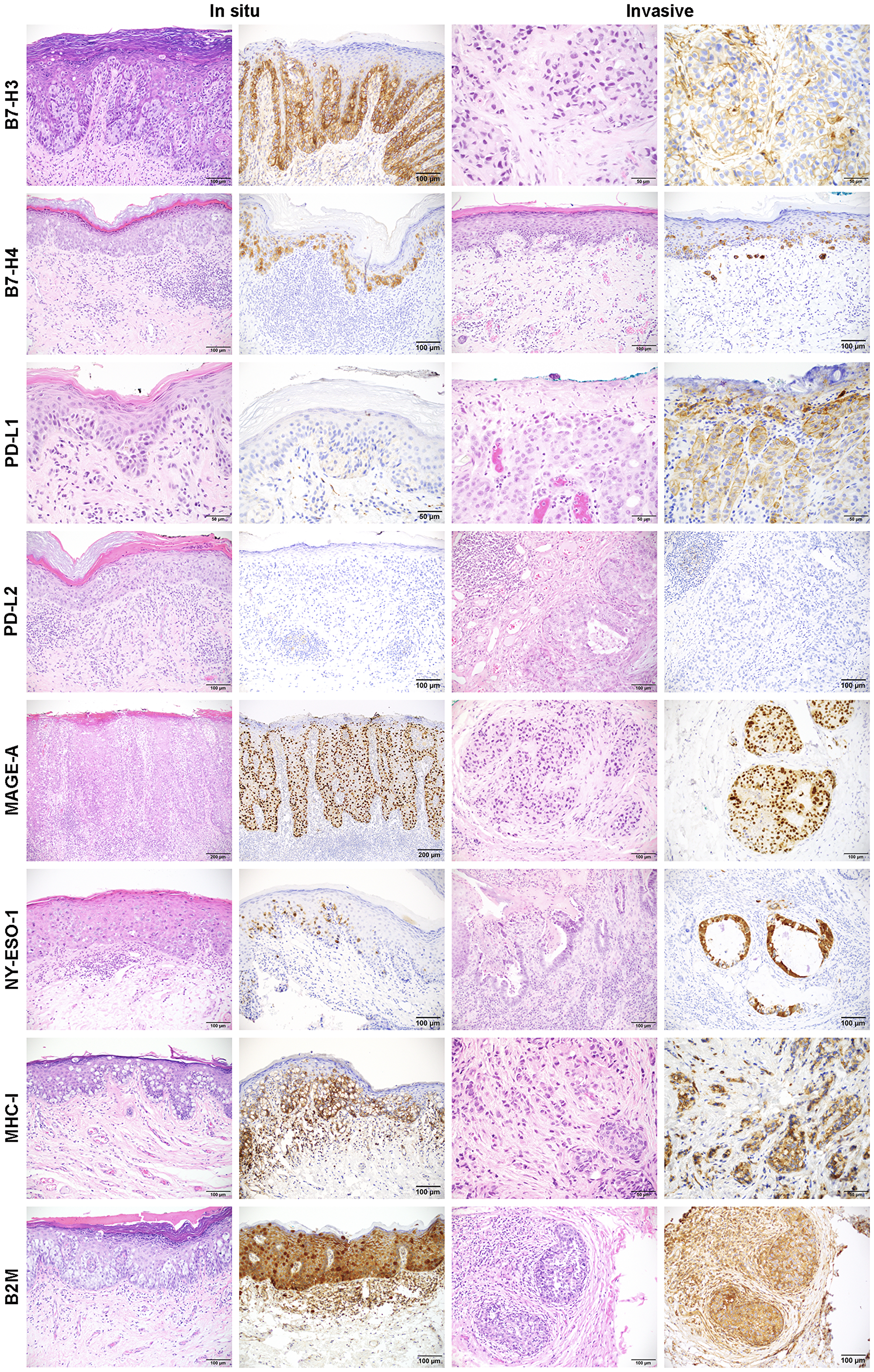 Representative images of immunohistochemistry for B7-H3, B7-H4, PD-L1, PD-L2, MAGE-A, NY-ESO-1, MHC-I, and B2M in in situ and invasive EMPD.