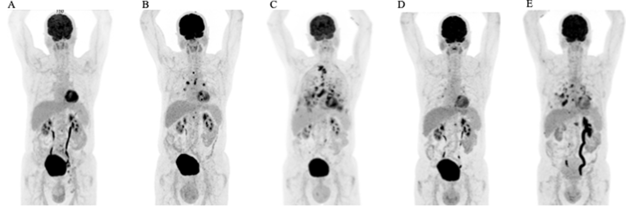 Therapeutic efficacy assessed by FDG-PET/CT scans.