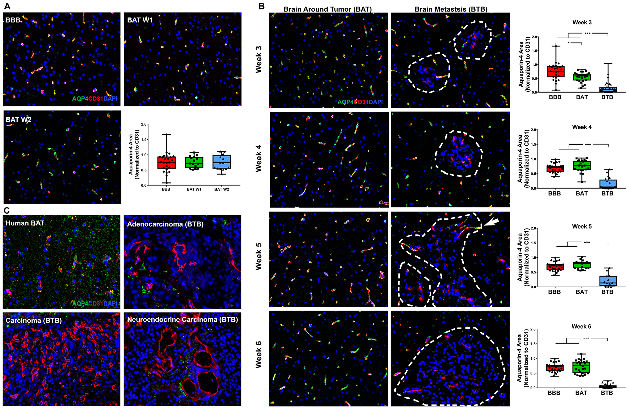 Catastrophic loss of the astrocytic endfeet water channel protein aquaporin-4 in NSCLC brain metastases.