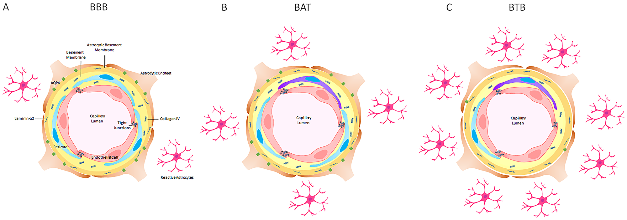 Figure 9: A schematic representation of the blood-brain barrier (BBB), brain around tumor region (BAT) and blood-tumor barrier (BTB) in late stage NSCLC brain metastases in an experimental model. (A)