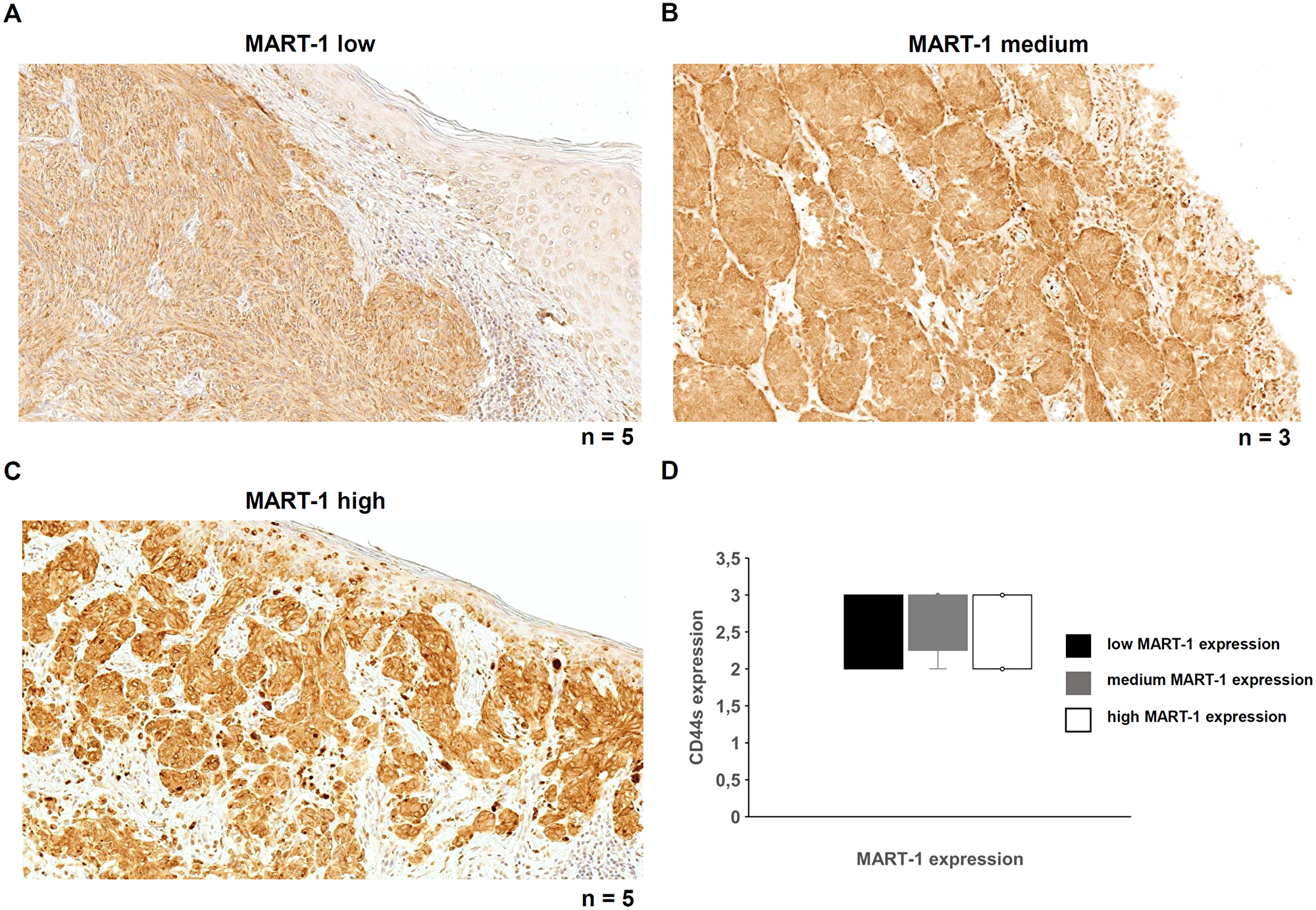 MART-1 expression and its correlation with CD44s expression in malignant melanoma.