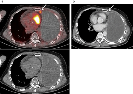 Local recurrence developed in a 67-year-old male following treatment for a malignant pleural mesothelioma, including neoadjuvant chemotherapy, left extrapleural pneumonectomy, radiotherapy, and chemotherapy.