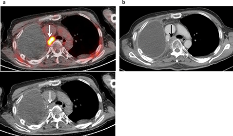 Lymph node recurrence developed in a 61-year-old male following treatment for a malignant pleural mesothelioma, including neoadjuvant chemotherapy, right extrapleural pneumonectomy, and radiotherapy.
